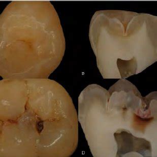 (PDF) Traditional and Novel Caries Detection Methods