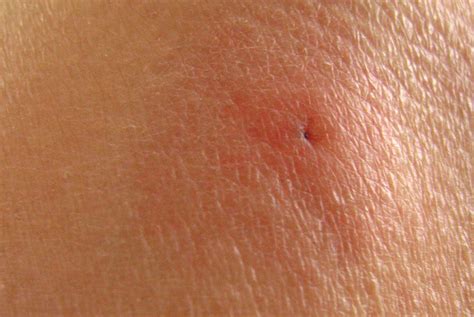 Do All Tick Bites Leave A Mark? Debunking The Myth Of Invisible Tick Bites