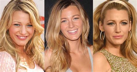 Blake Lively Plastic Surgery