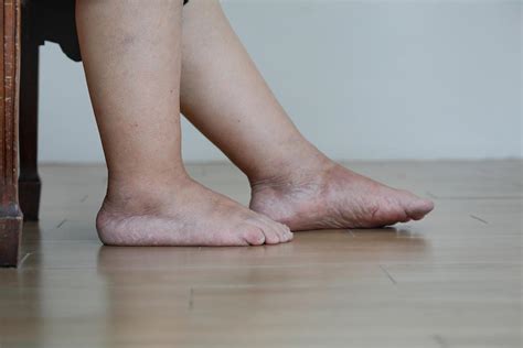 When Should I See a Doctor About Leg Swelling?: Madaiah Revana, M.D., F.A.C.C.: Interventional ...