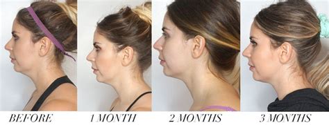 Before and after CoolSculpting double chin area, 90 day results ...