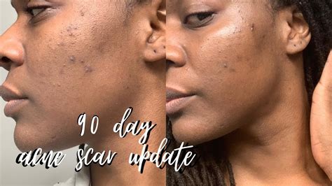 I used Derma E scar gel for 90 days to lighten my acne scars... | 90 Day Update - YouTube