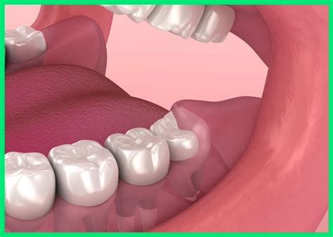 Wisdom Tooth Pain: How to Manage It at Home | Wisdom Tooth Wiki