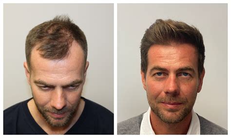 Hair Transplant Before and After - TOP 10 Pictures in 2023