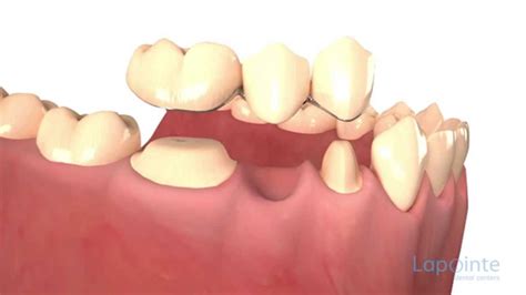 Dental bridges types - Lapointe dental centres - Dental Clinic