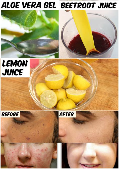 Does Lemon Juice Get Rid Of Acne Scars - HOWOTREMVO