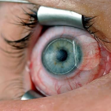 Femto LASIK- Procedure, Benefits, Risks, Cost and More