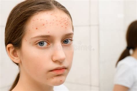 Face of a Teenage Girl with Pimples, Acne on the Skin, she Looks at ...