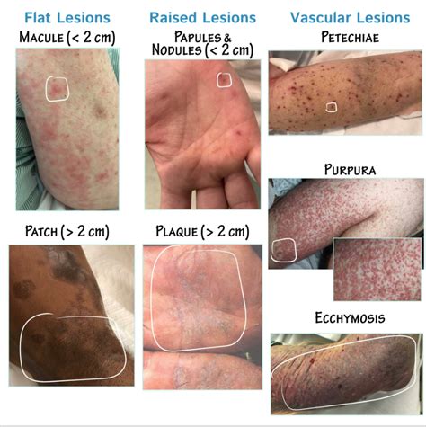 Clinical Pathology Glossary: Common Dermatologic Findings | ditki ...