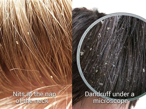 Lice Eggs Compared To Dandruff - Lice Eggs - EroFound