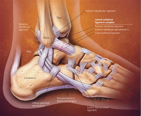 High Ankle Sprain vs. Ankle Sprain: What’s the Difference? | HSS (2022)