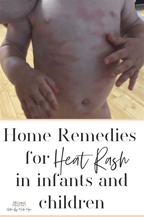 5 Effective Home Remedies for Baby Heat Rash | Heat rash, Baby heat ...