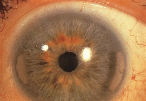 Corneal Band Keratopathy