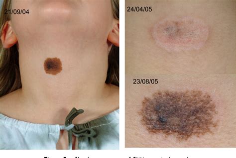 Congenital Nevus Removal Before And After