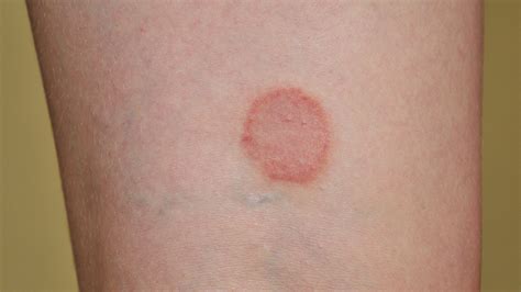 Ringworm In Humans Treatment