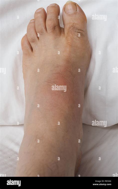 A swollen left foot with gout Stock Photo, Royalty Free Image: 91081374 - Alamy