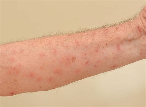 Scabies Outbreaks in Nursing Homes | Pintas & Mullins