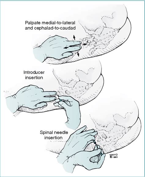 Figure 12-10 from Spinal, Epidural, and Caudal Anesthesia: Anatomy ...