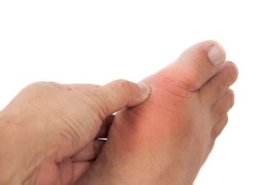 Sprained Toe Diagnosis and Treatment | Minnetonka Foot Care