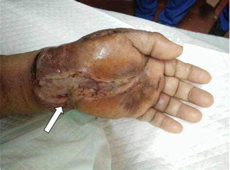 Cureus | Tuberculosis of the Left Wrist Joint and Spine