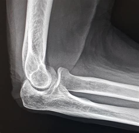 How to fix this elbow please. (Tips on correcting lateral elbow) : Radiology