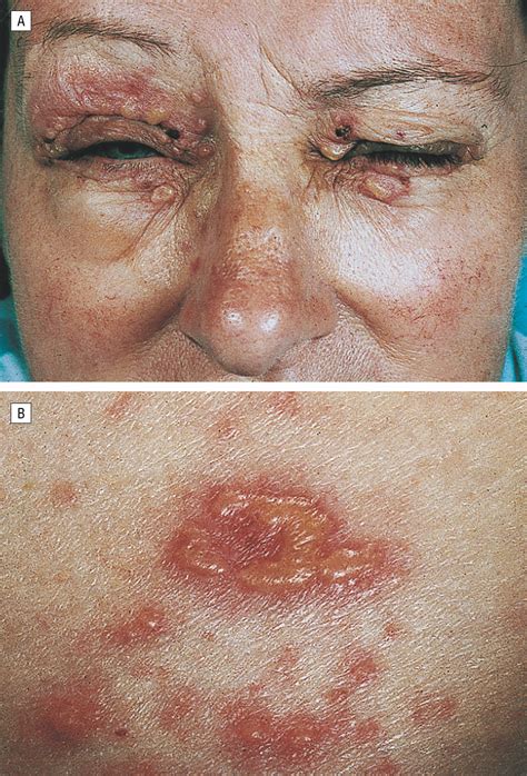 Epidermolysis Bullosa Acquisita Histology