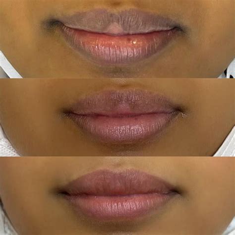 All About Laser Lip Lightening: Effects, Cost, Risks