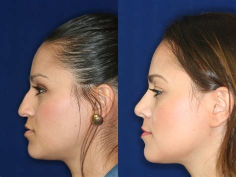 Hispanic Rhinoplasty in Beverly Hills | Dr. Robert Kotler