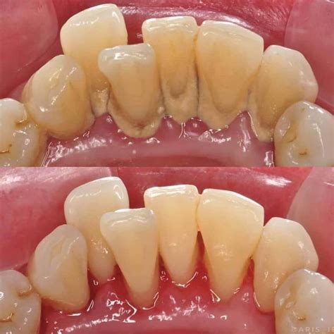 Full Mouth Debridement