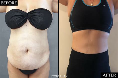 Airsculpt Breast Before And After - www.inf-inet.com