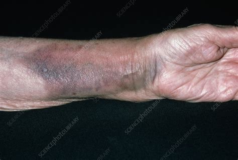 Bruising on a woman's arm due to fractured radius - Stock Image - M330/0531 - Science Photo Library