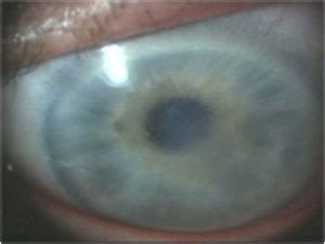 Corneal Edema – Phoenix Eye Doctors