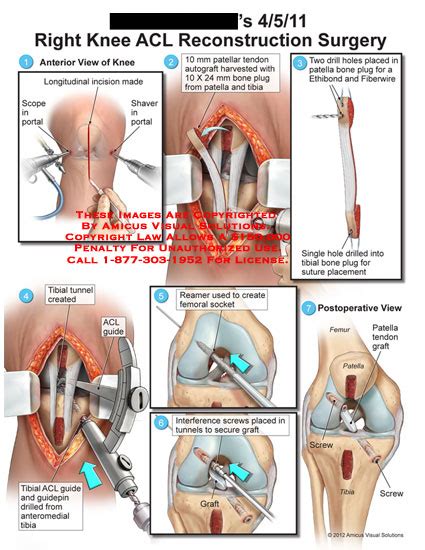 Right Knee ACL Reconstruction Surgery