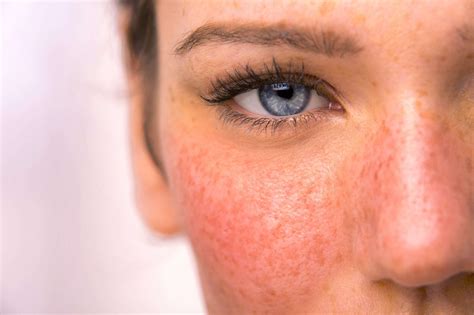 Rosacea: 7 Treatment Options