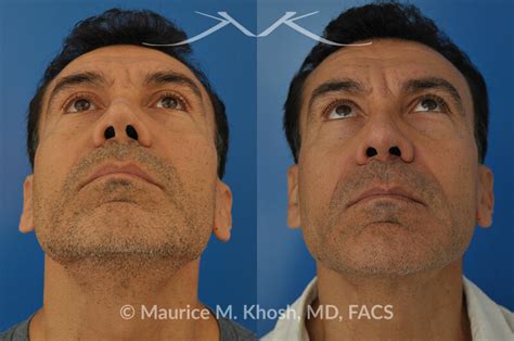 10+ Nasal Valve Collapse Surgery Before And After - SaphireAmmara