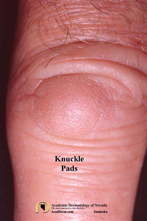 Knuckle Pads: Heloderma... - Academic Dermatology of Nevada