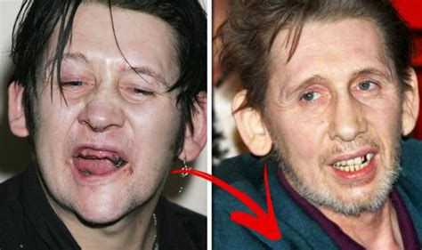 Shane MacGowan's teeth: Before and after transformation | Express.co.uk