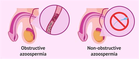 Types of azoospermia