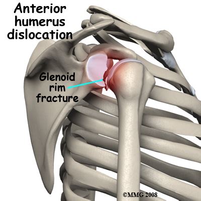 Occupational Therapy in Wyckoff, Ridgewood for Shoulder Pain - Adult Fractures