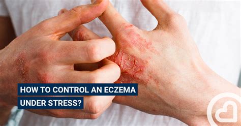 How to control an eczema under stress? – Articles – Familiprix