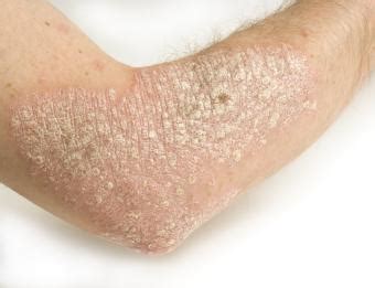 Pictures of Skin Rashes | LoveToKnow Health & Wellness