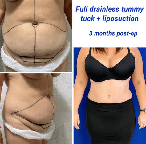 4 Simple Tips for Your Drainless Tummy Tuck Recovery - Harley Clinic