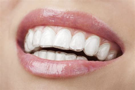 Tips For Cleaning Invisalign - KIMIA FAMILY DENTISTRY