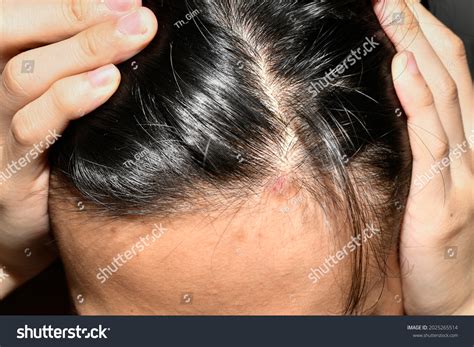 240 Scalp Ringworm Images, Stock Photos & Vectors | Shutterstock