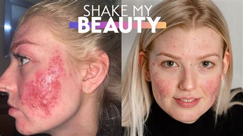 My Cystic Acne Is So Bad It Went Viral | SHAKE MY BEAUTY - YouTube