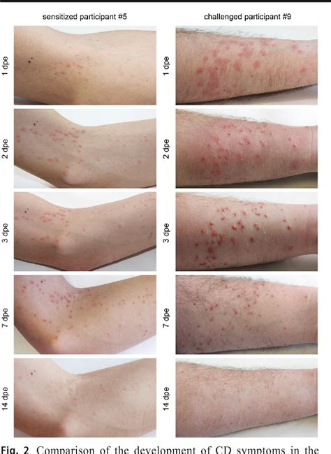 Figure 8 from Cercarial dermatitis: a systematic follow-up study of human cases with ...