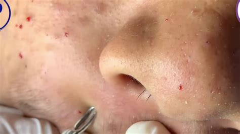 New Blackhead Removal Oct 28 2025 - Devan Fenelia