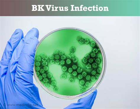 BK Virus Infection - Risk Factors, Symptoms, Signs, Diagnosis, Treatment, Prognosis