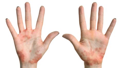 Mild Psoriasis On Hands