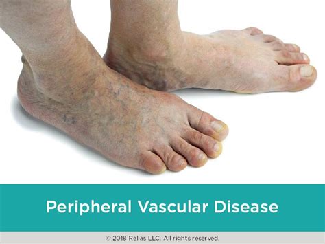 vascular disease legs pictures Frequently asked questions about peripheral artery disease ...